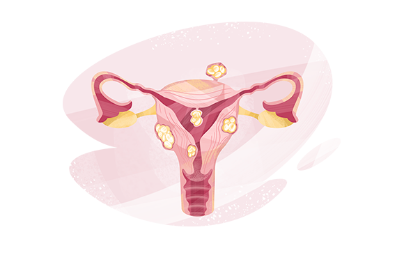 A diagram of a uterus with fibroids.