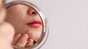 Health: Acne: close up acne mirror-1332410621
