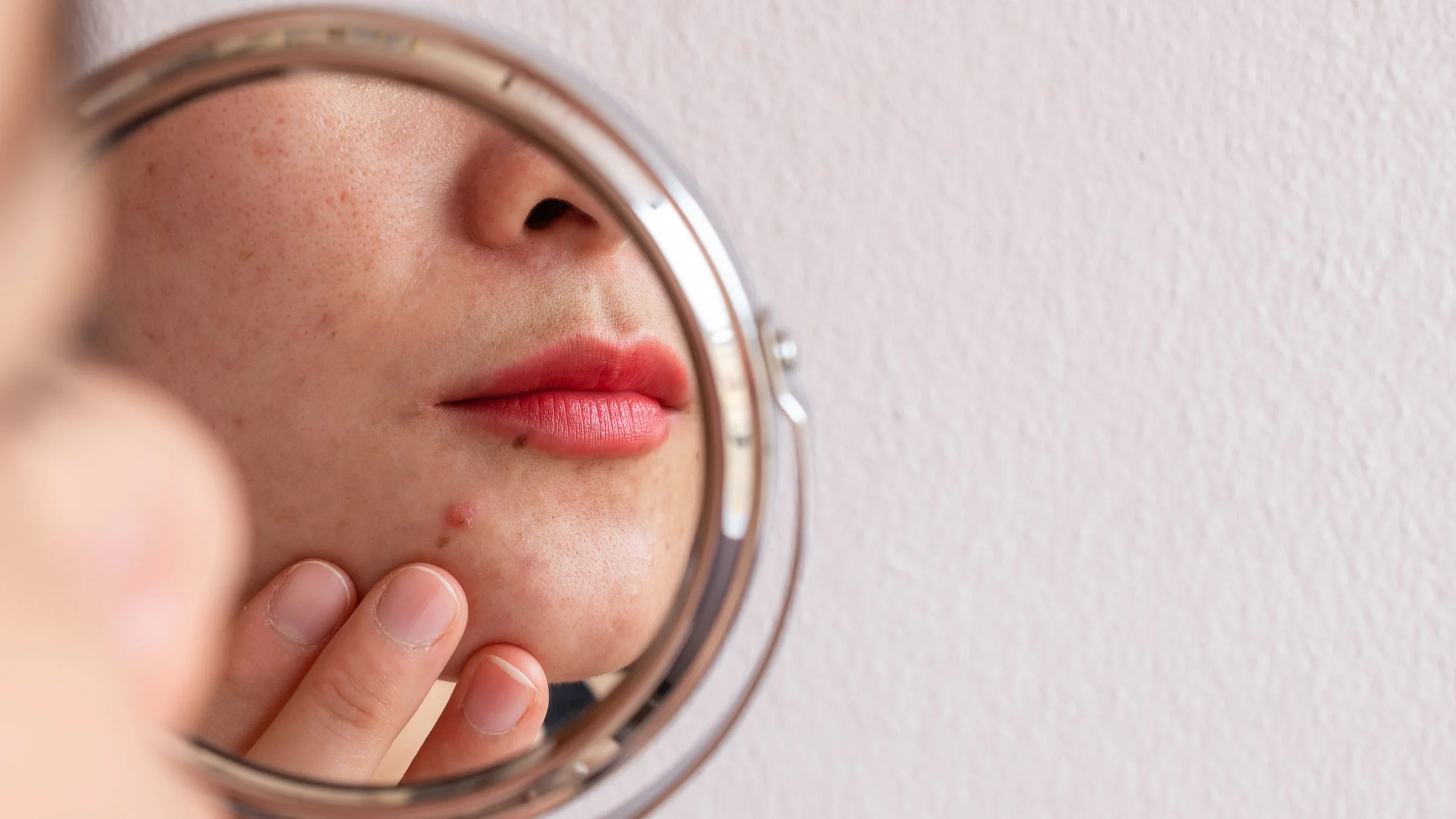 Close-up woman looking at acne in mirror.