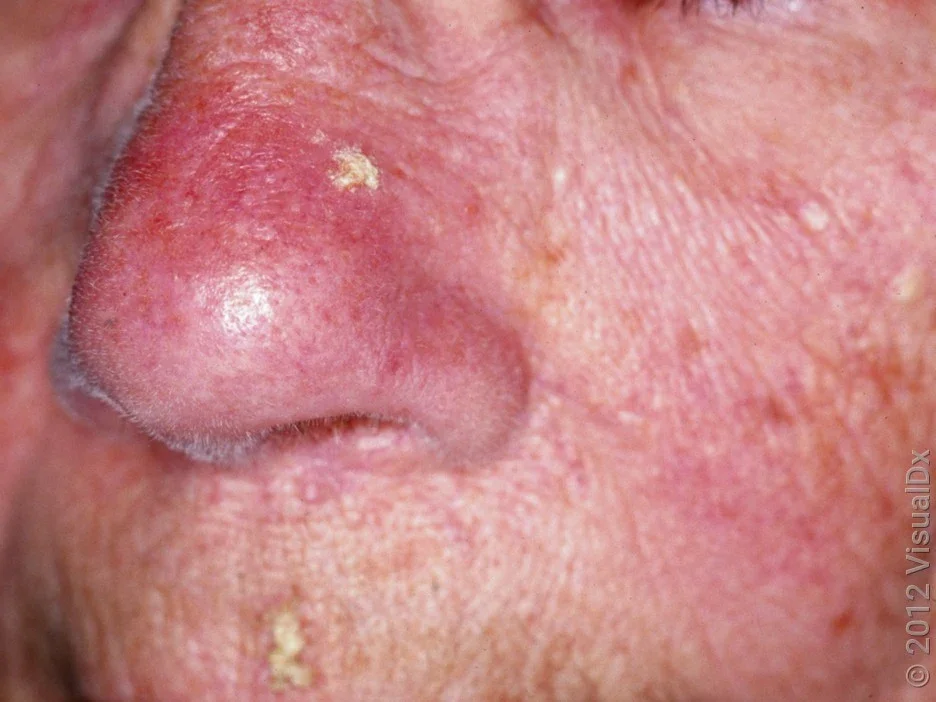 Close-up of several actinic keratoses on the face.