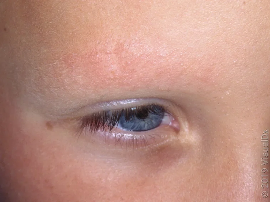 Dandruff causes red, discolored, and flaky eyebrows.