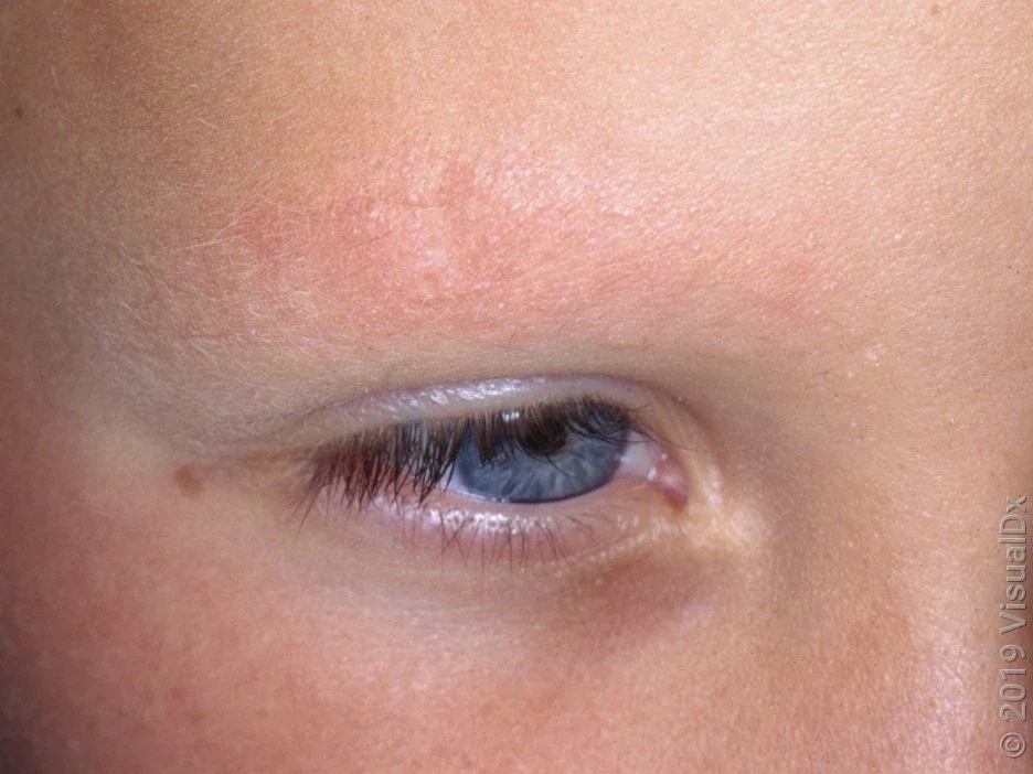 Dandruff causes red, discolored, and flaky eyebrows.