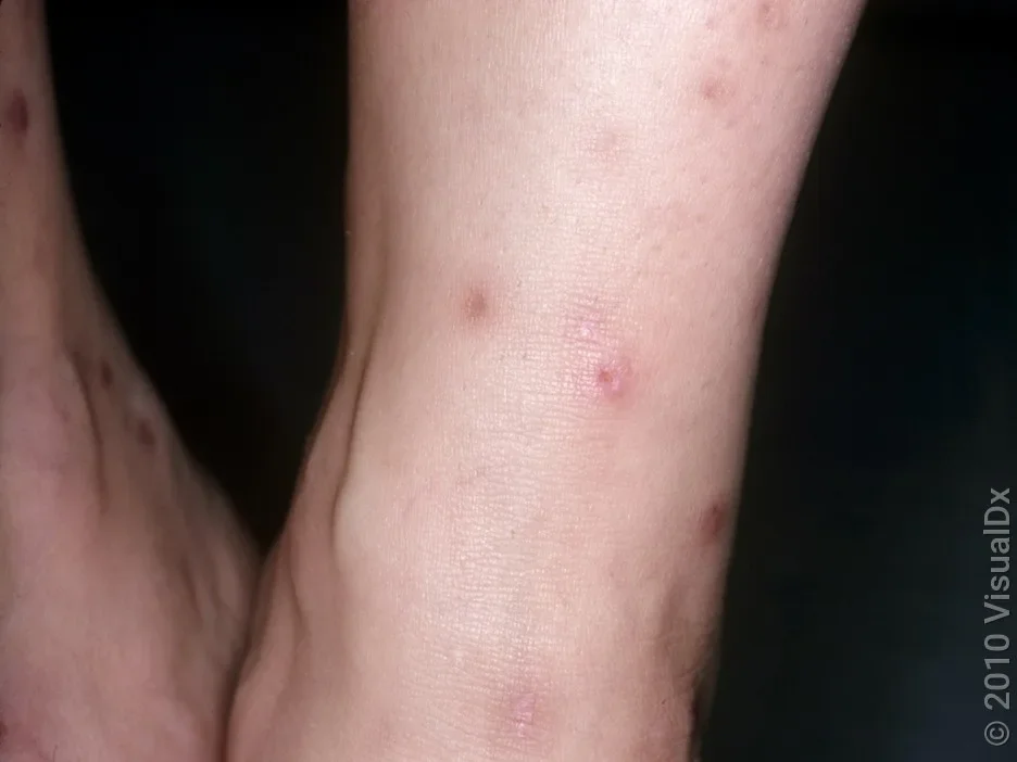 Flea bites at different stages around the ankle.