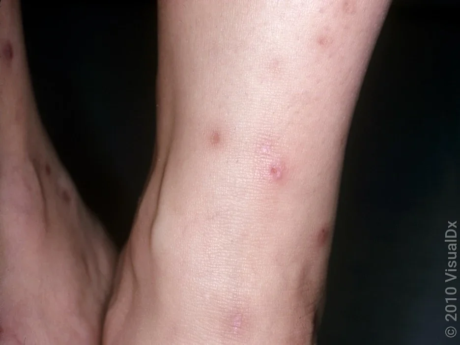 Flea bites at different stages around the ankle. 