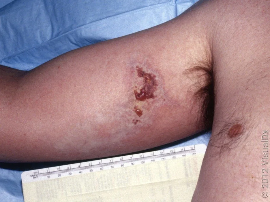 Close-up of an arm with a crusty ulcer surrounded by whitish skin.