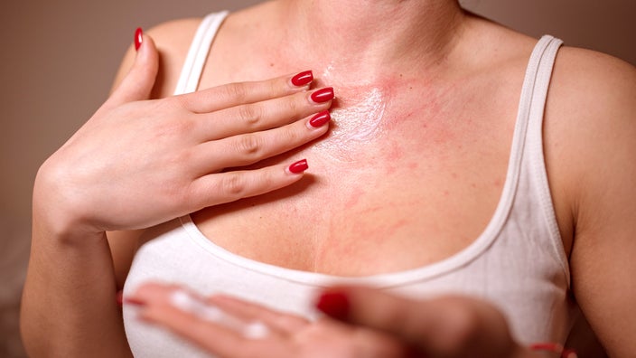 Close-up of a woman’s chest with a red rash. She is applying ointment or cream to it.