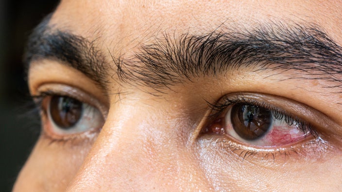 Close-up of a man's red bloodshot eyes.