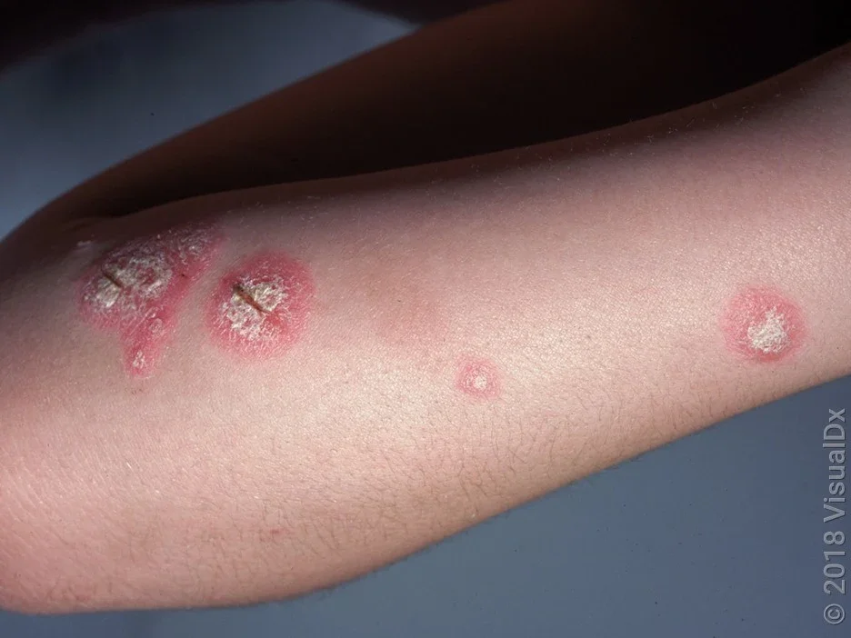 Close-up of an arm with pink, scaly patches in psoriasis. 