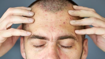 Dermatology: closeup face with chickenpox 1316322791