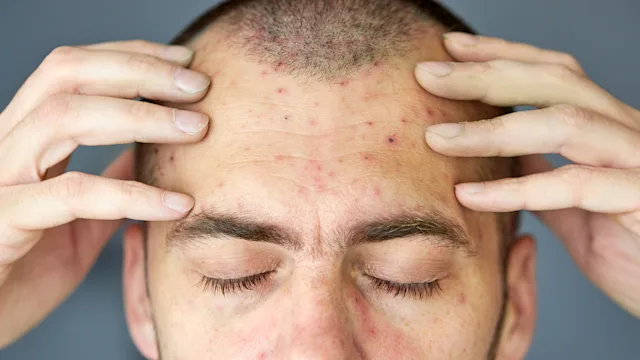 Dermatology: closeup face with chickenpox 1316322791