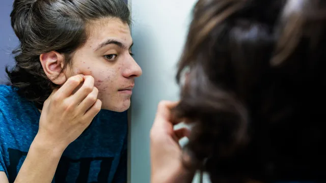 Dermatology: looking at acne in mirror 1324430642
