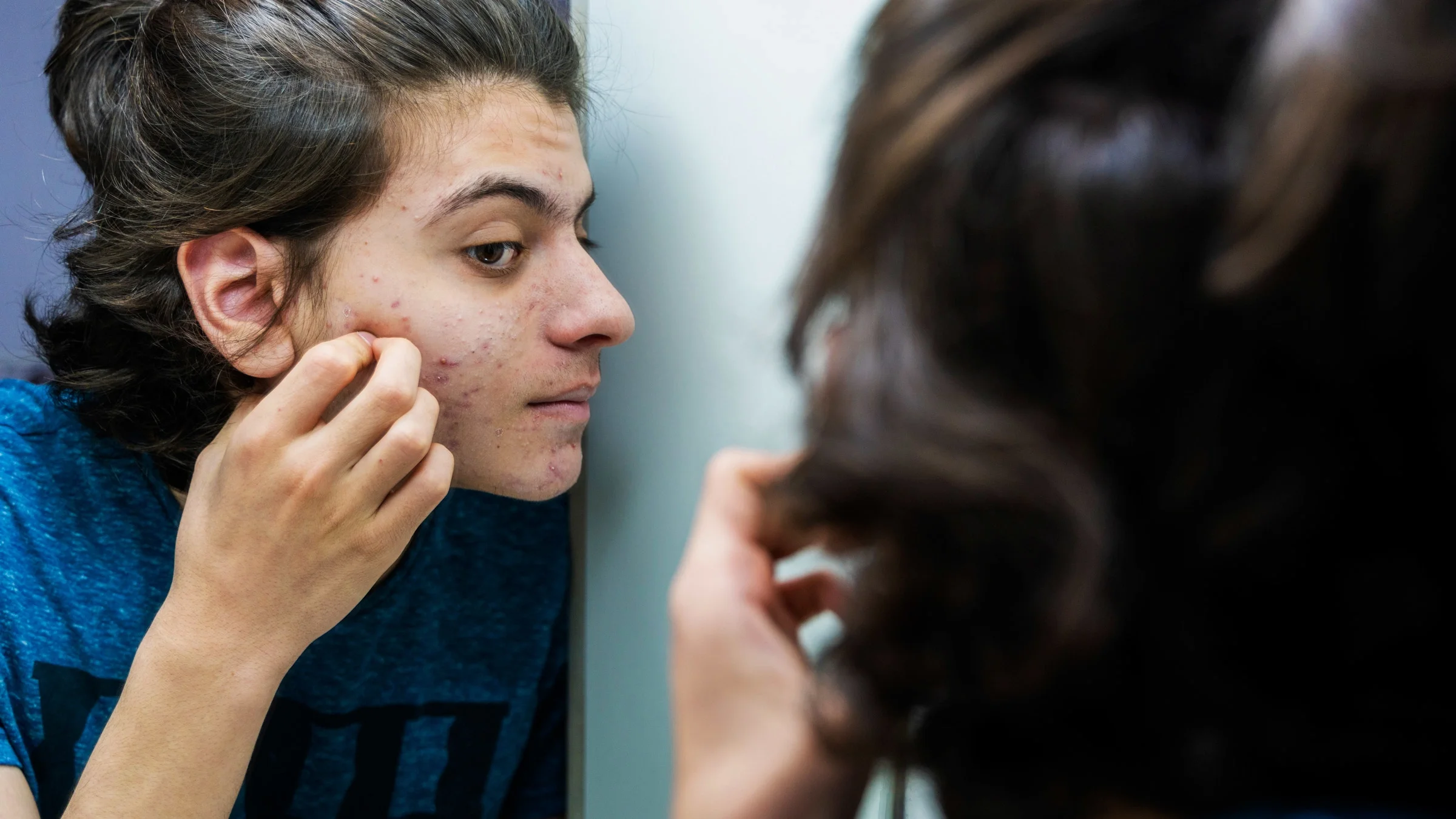 A teenager looking at their acne in the mirror. Having a pimple is a nuisance, and there are ways you can get rid of it quickly, such as applying benzoyl peroxide cream. 