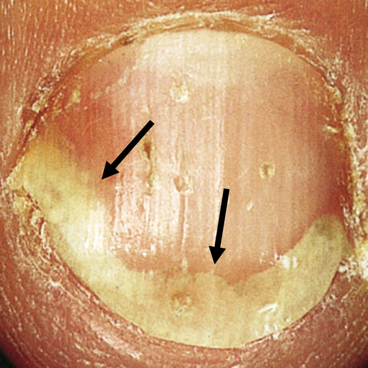 Psoriatic Arthritis Nail Symptoms: 6 Common Signs - GoodRx Psoriatic Arthritis Nail Symptoms: 6 Common Signs - GoodRx