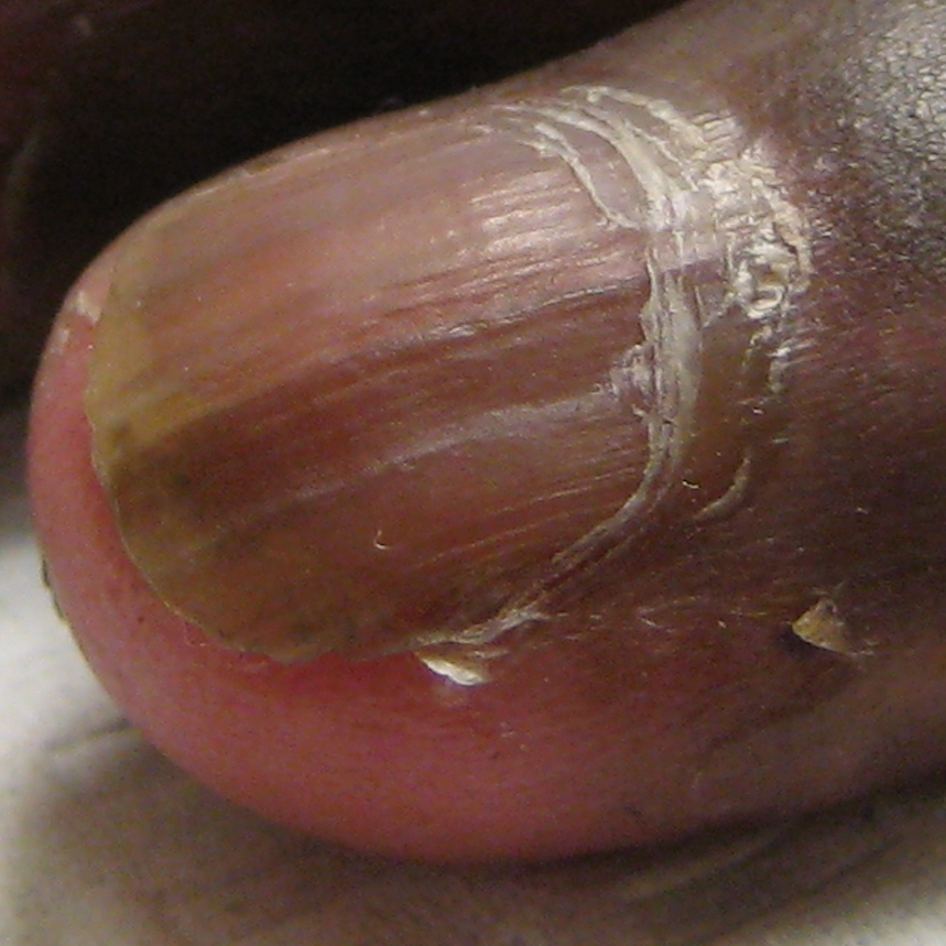 Psoriatic Arthritis Nail Symptoms: 6 Common Signs - GoodRx Psoriatic Arthritis Nail Symptoms: 6 Common Signs - GoodRx