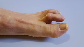 Health: Musculoskeletal: closeup foot with hammer toe 1280033268