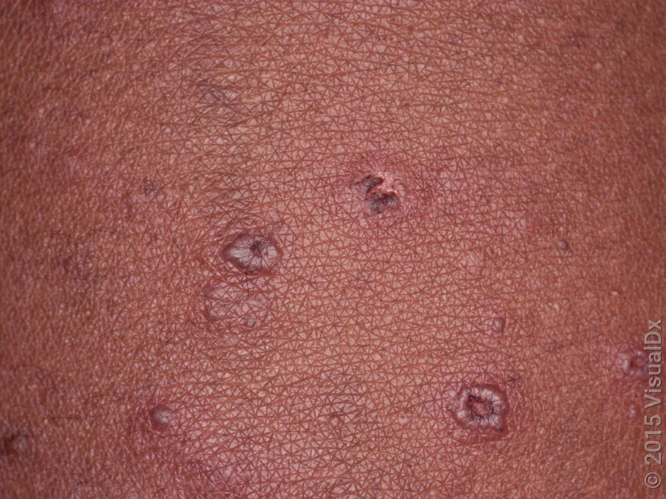 Chickenpox scabs on darker skin tone. 