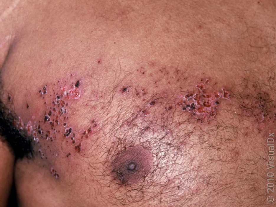 Shingles rash with some crusting. 