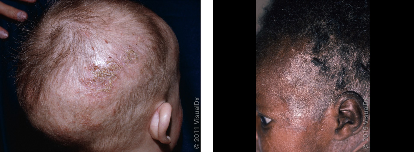 What Is Scalp Eczema? Treatment, Causes, Triggers, & Images GoodRx