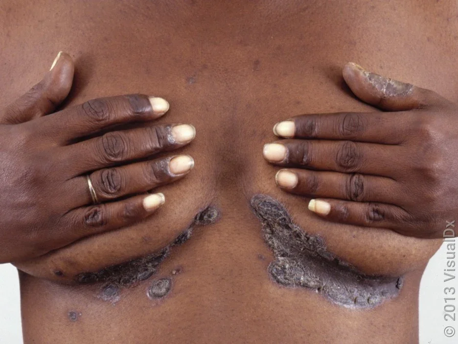 Close-up of inverse psoriasis under the breasts. 