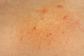 Molluscum Contagiosum Treatment Options - GoodRx