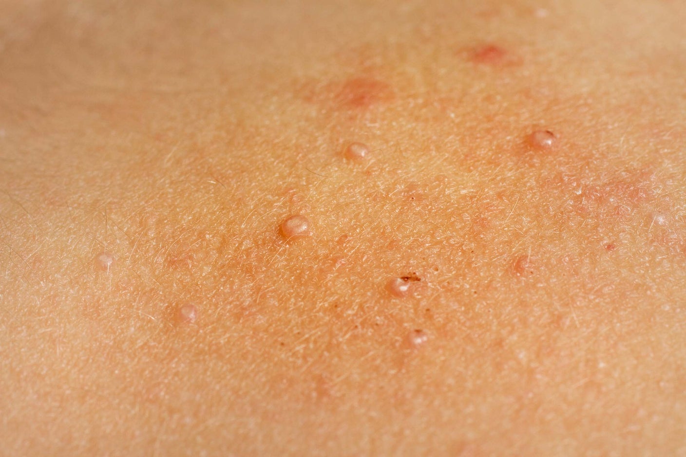 What Is Molluscum Contagiosum Pictures Causes And Treatment Goodrx
