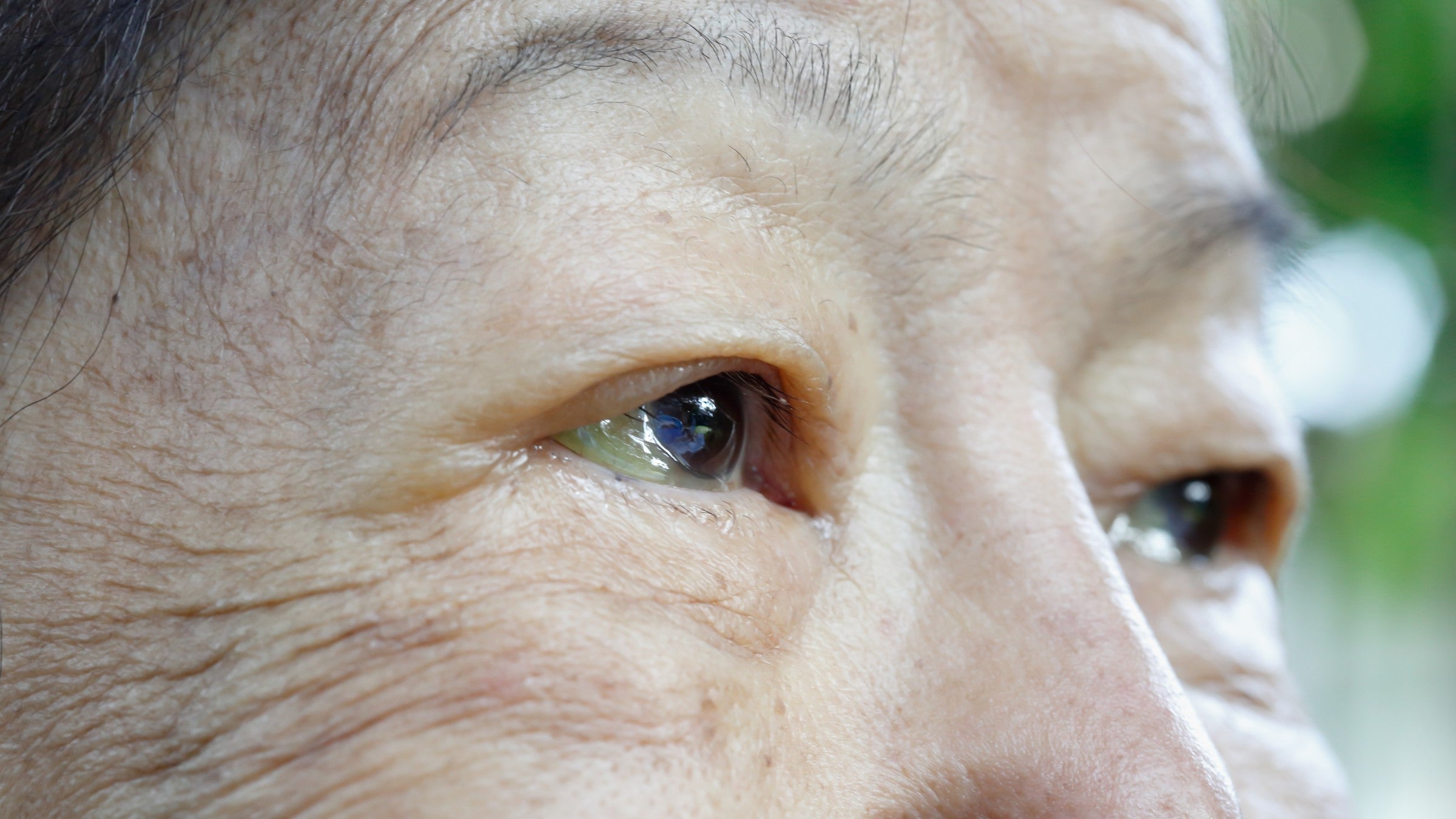 hepatitis c : GettyImages 1173706124