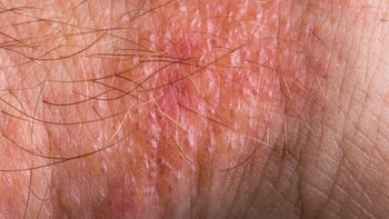 Dermatology: Rash: Poison Ivy: closeup poison ivy rash on skin 618621144