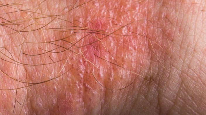 A close-up look at a poison ivy rash on a person’s skin.
