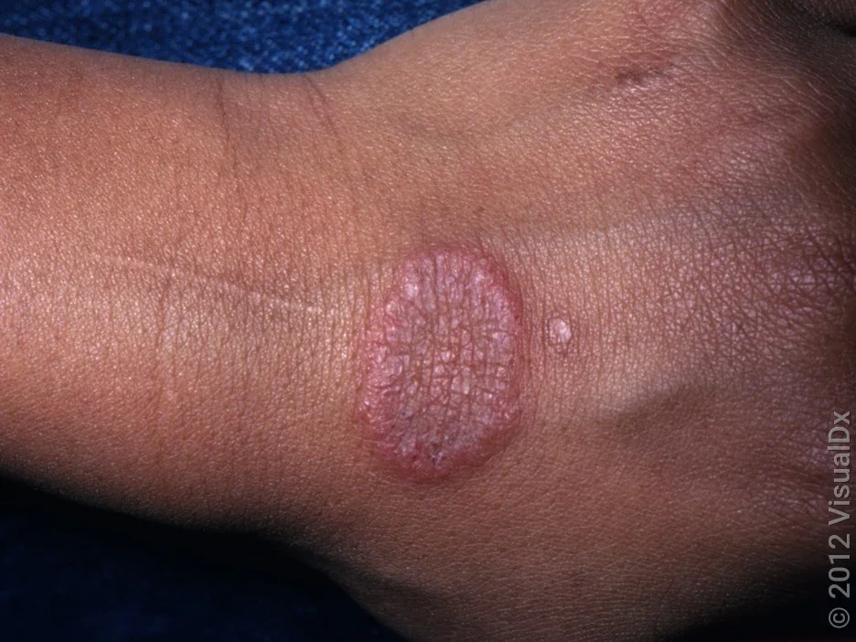 Close-up of ringworm on the hand. 