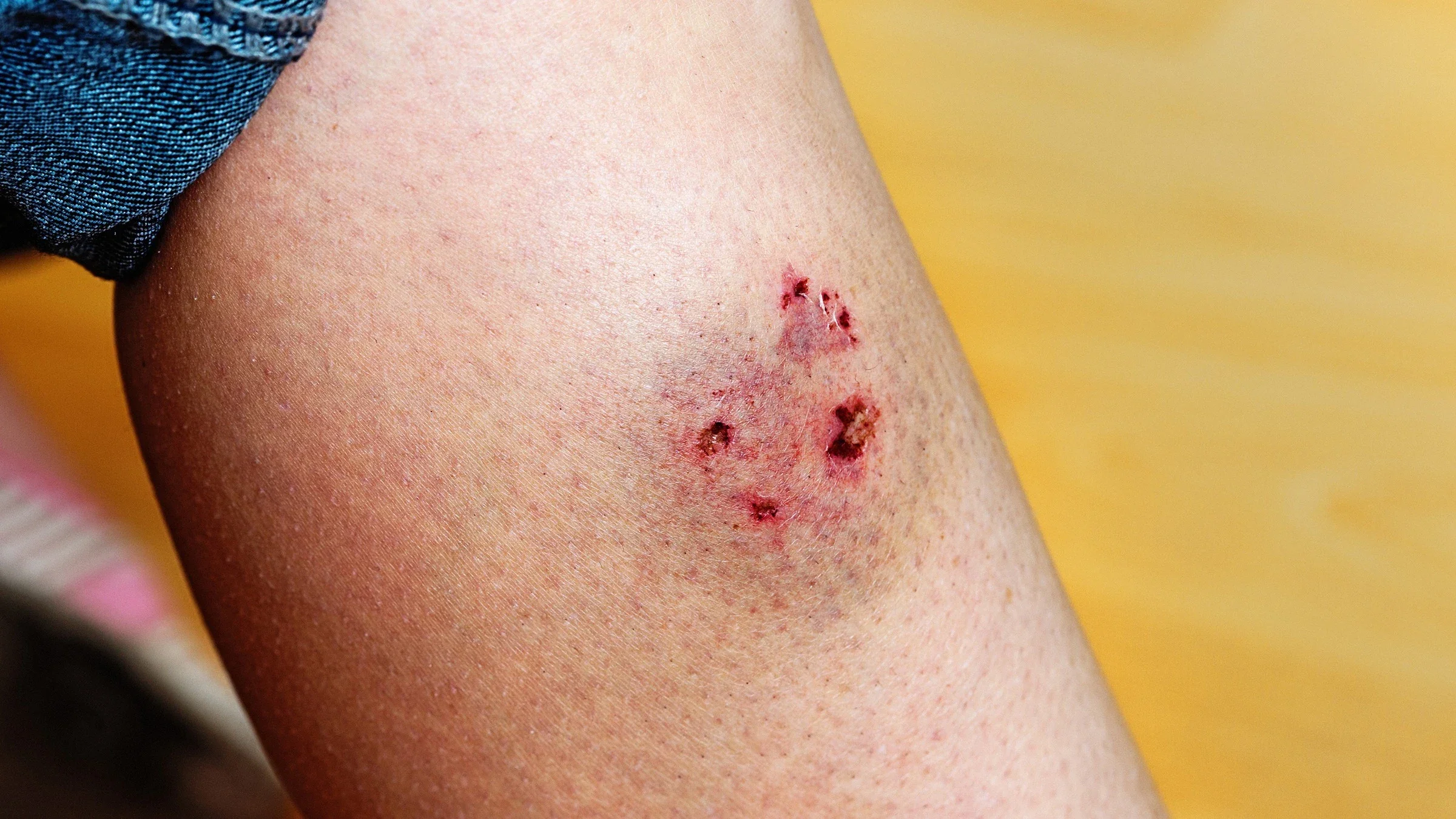 Extreme close-up of a dog bite on someone's leg.
RapidEye/iStock via Getty Images