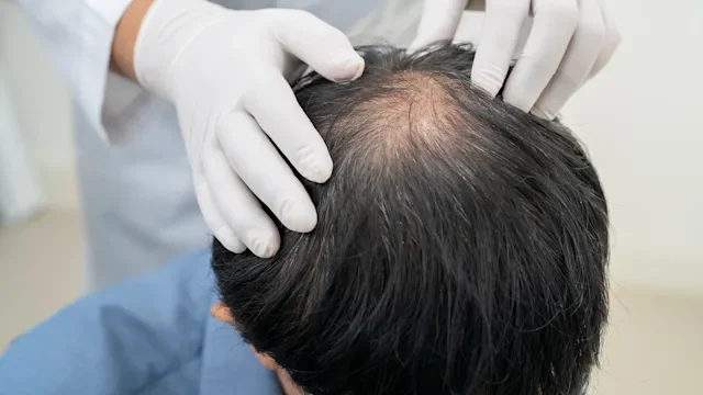 Men's Health: Hair Loss: closeup hair loss treatment 2152716751