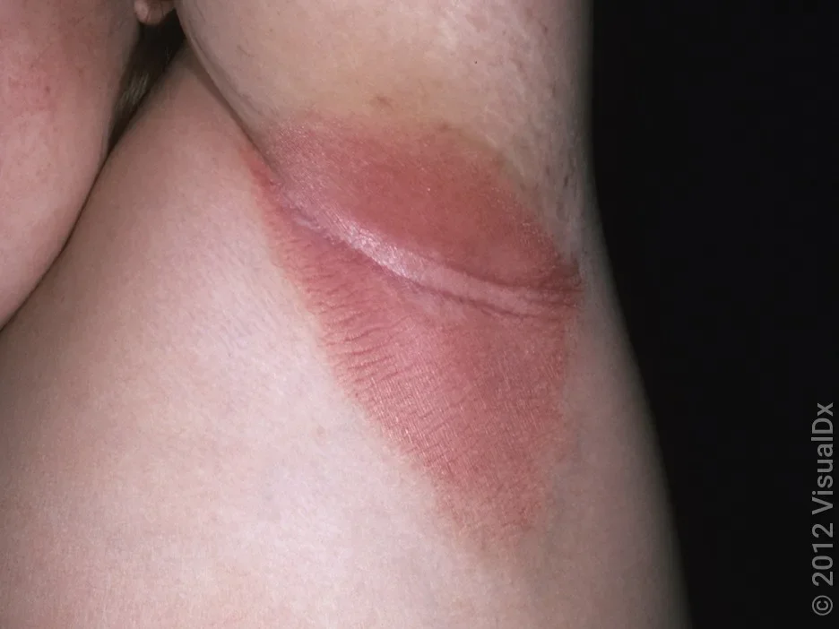 Close-up of an armpit with a pink patch in inverse psoriasis.