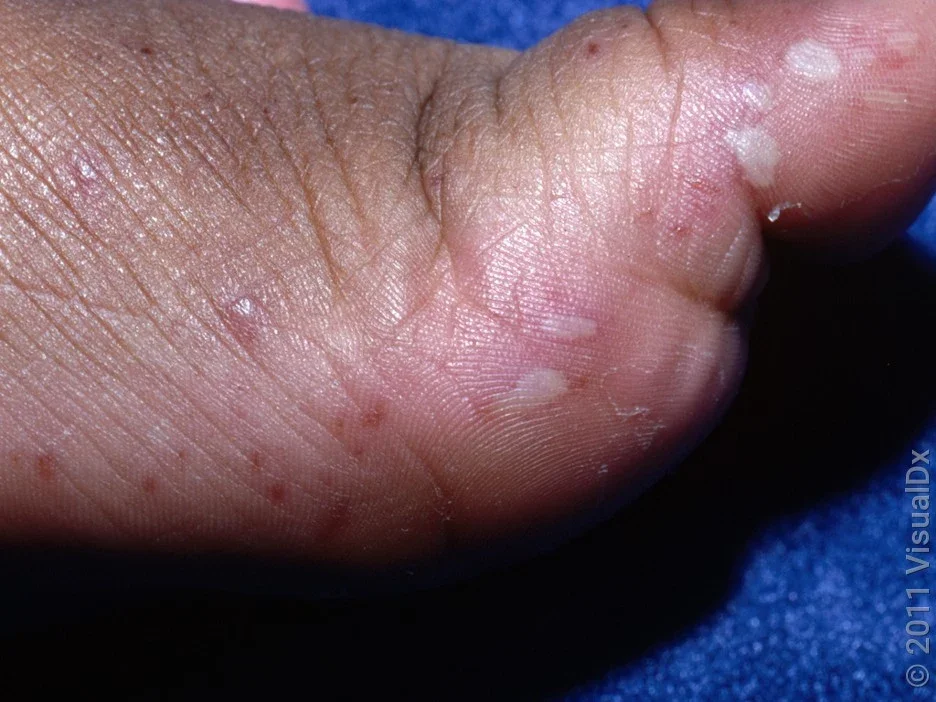 Blisters on the foot caused by hand, foot, and mouth disease. 