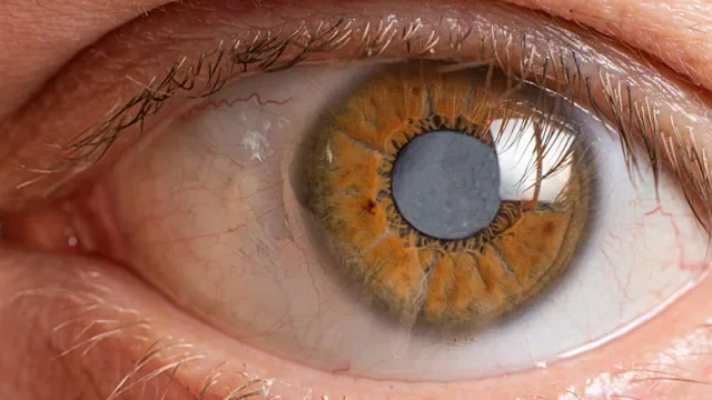 Eye: cataracts eye closeup-1290688606