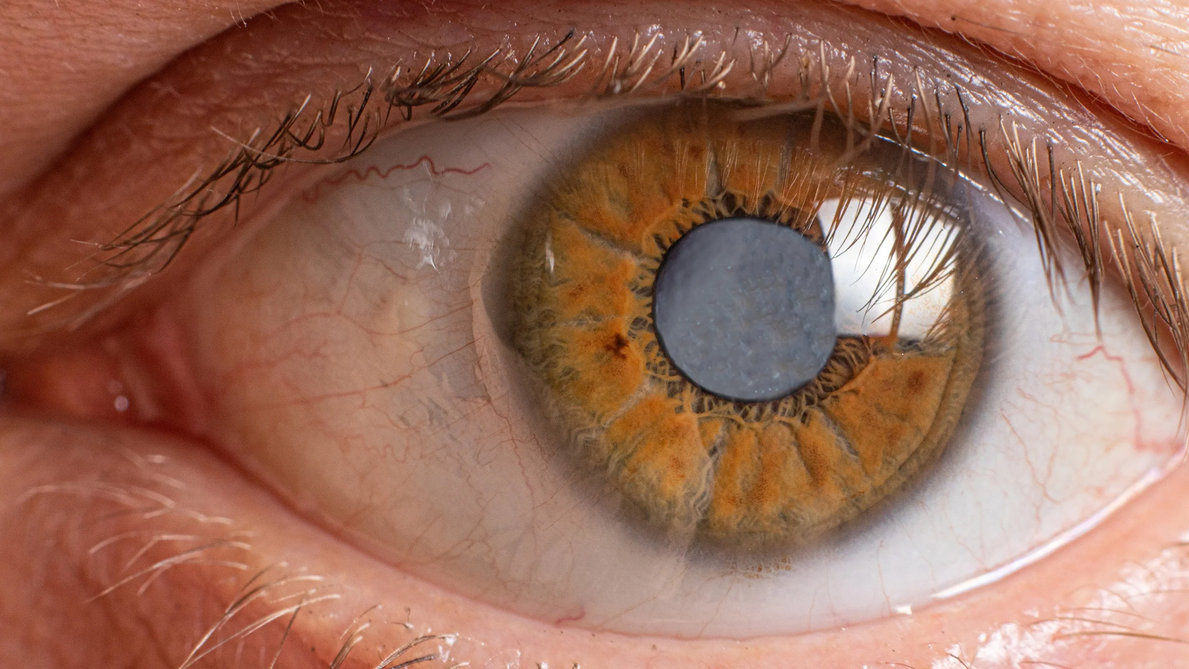Extreme close-up on a person's eye with a cataract.