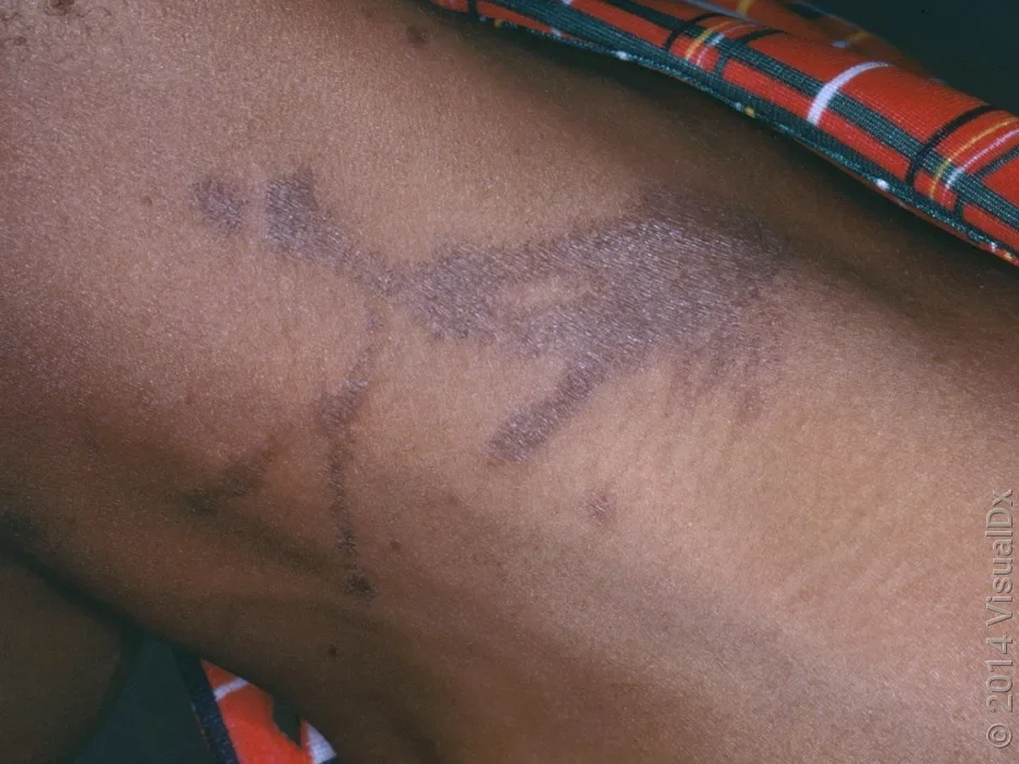 Dark streaks caused by poison ivy.