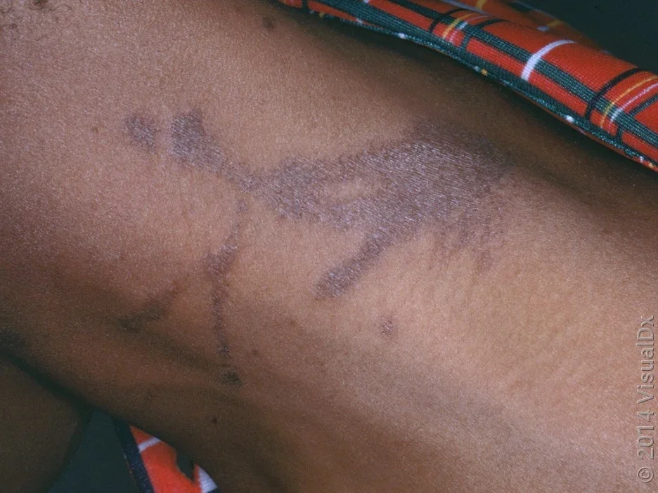 Dark streaks caused by poison ivy.