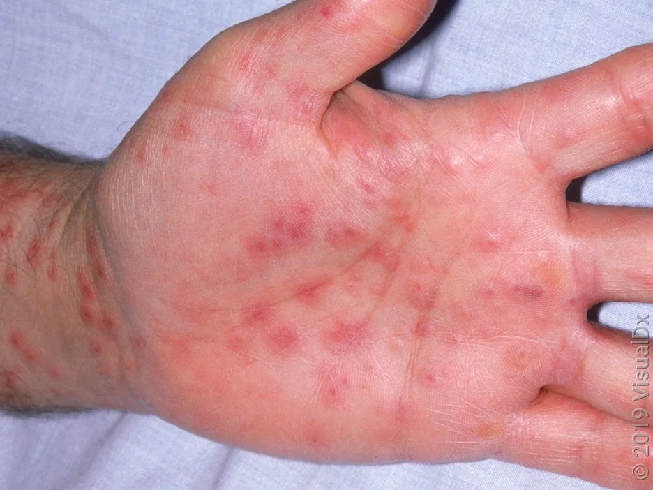 A look at an SJS rash on a person’s hand.