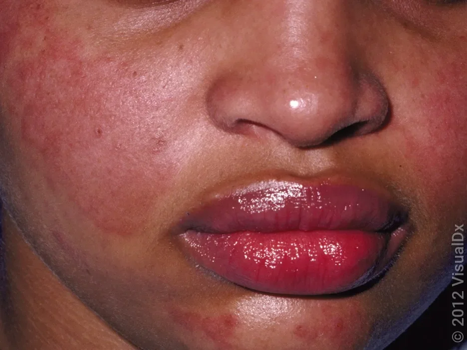 A lupus butterfly face rash in a darker skin tone.