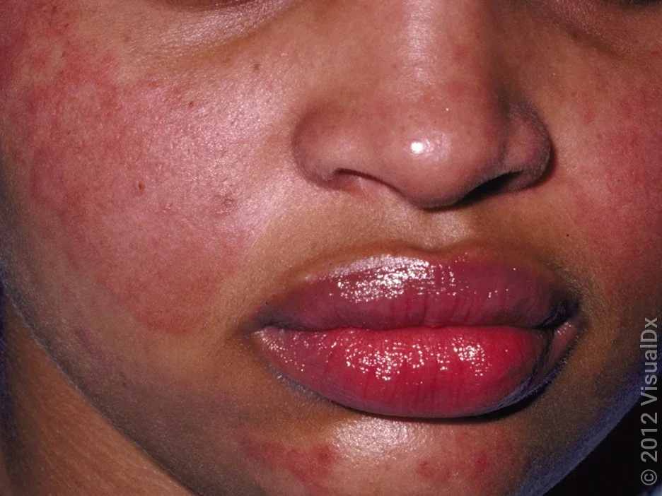 A lupus butterfly face rash in a darker skin tone. 