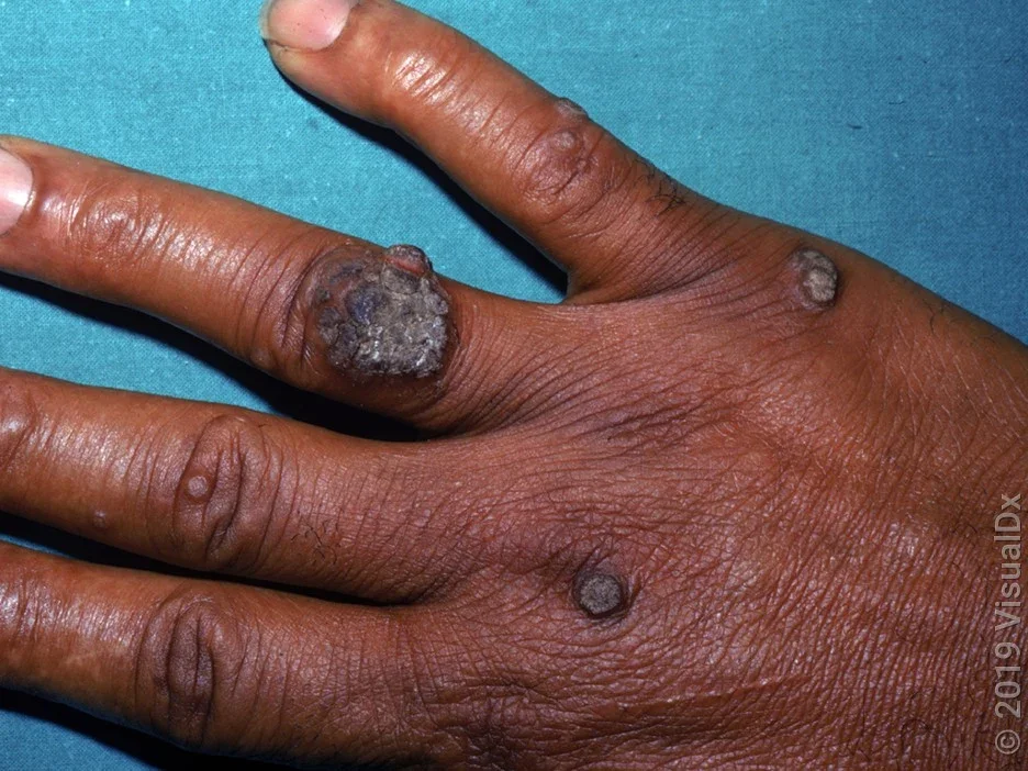 Several common warts of different sizes on the back of the hand.