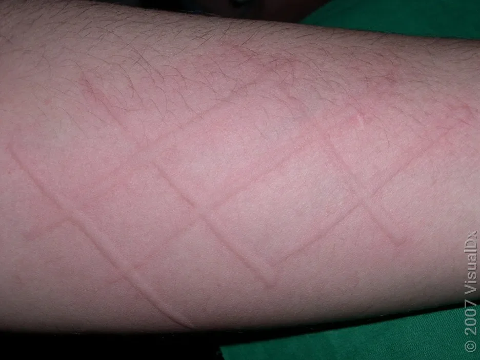Close-up of pink lines in dermatographia.