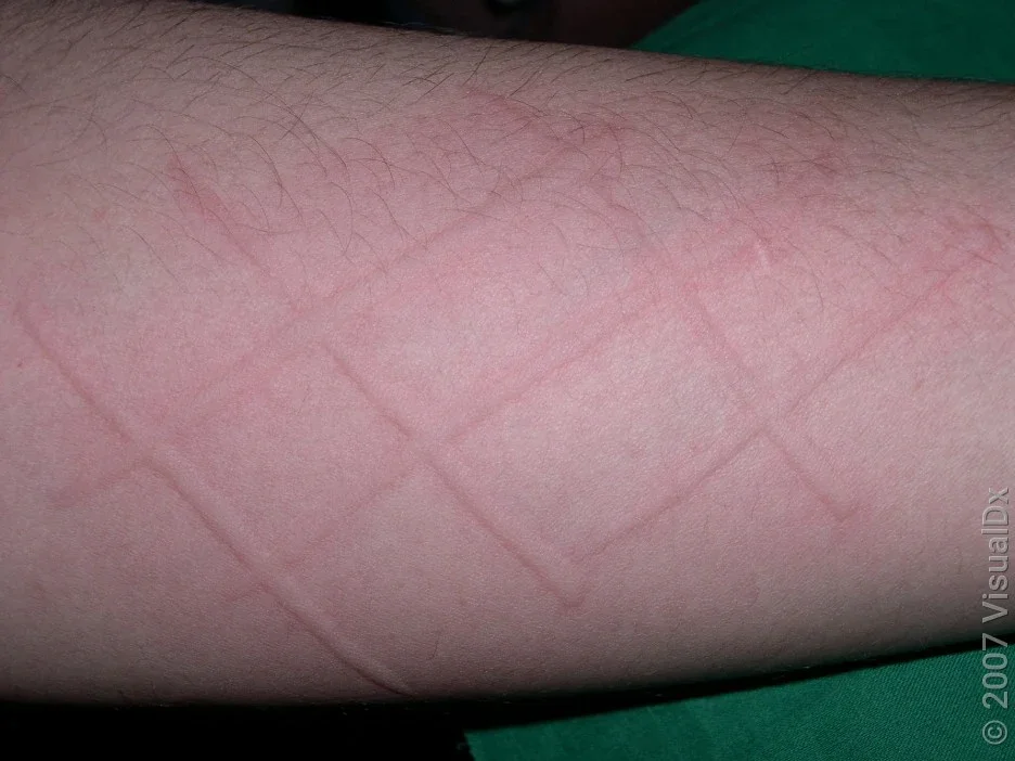 Close-up of pink lines in dermatographia. 