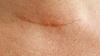 Health: Thyroid: thyroidectomy scar neck-623699882