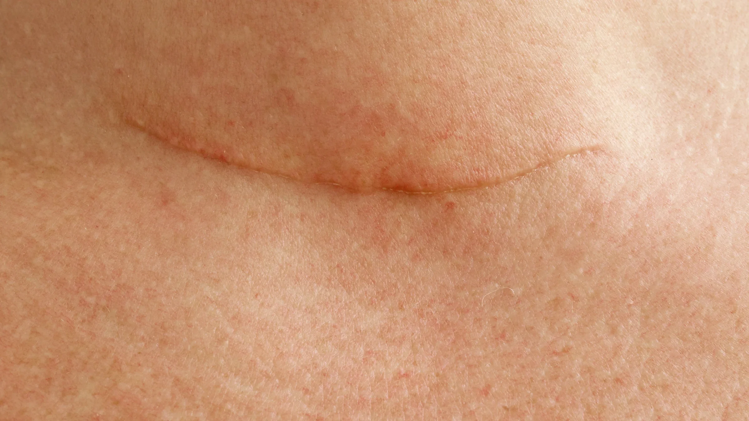 Health: Thyroid: thyroidectomy scar neck-623699882