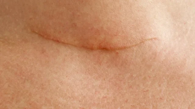 Health: Thyroid: thyroidectomy scar neck-623699882
