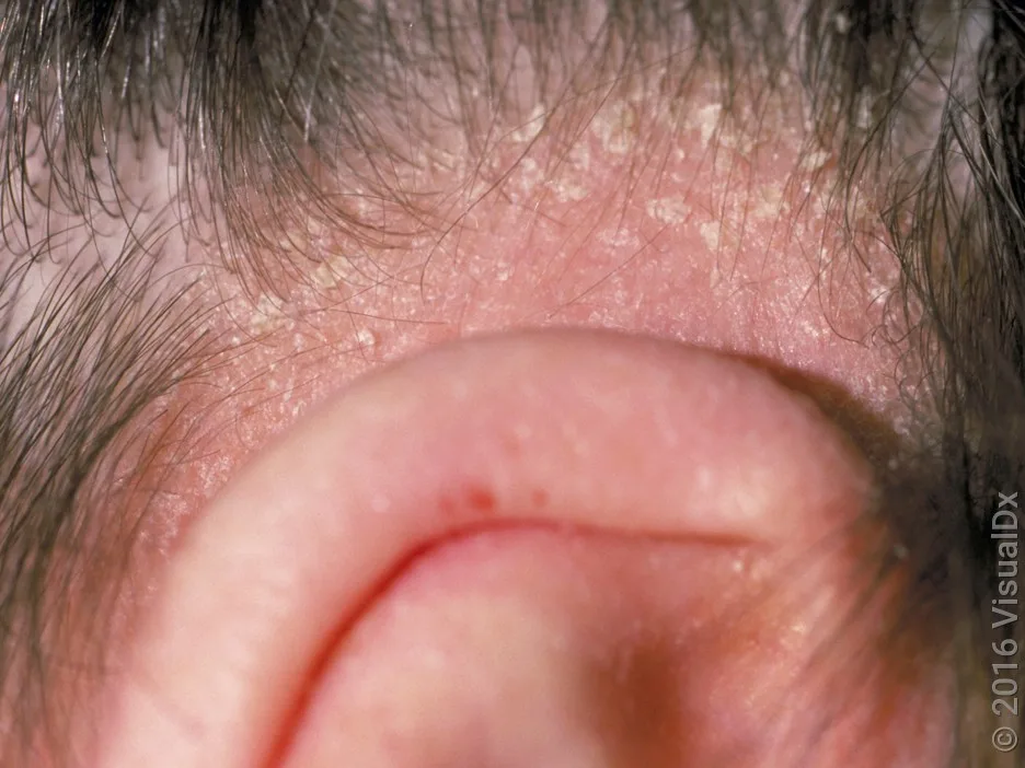 Close-up of dandruff flakes around the hairline.