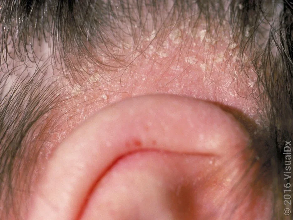Close-up of dandruff flakes around the hairline.