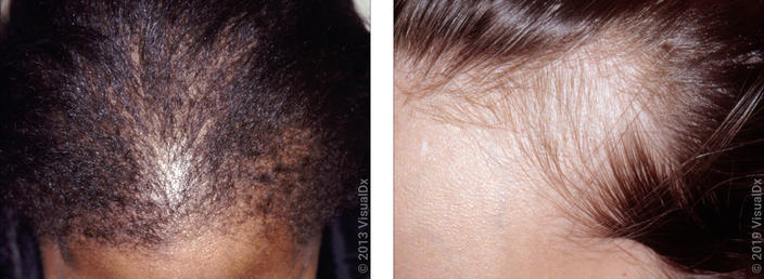 Left: Close up of frontal scalp with diffuse hair loss in telogen effluvium. Right: Close up of temple with hair loss in telogen effluvium.