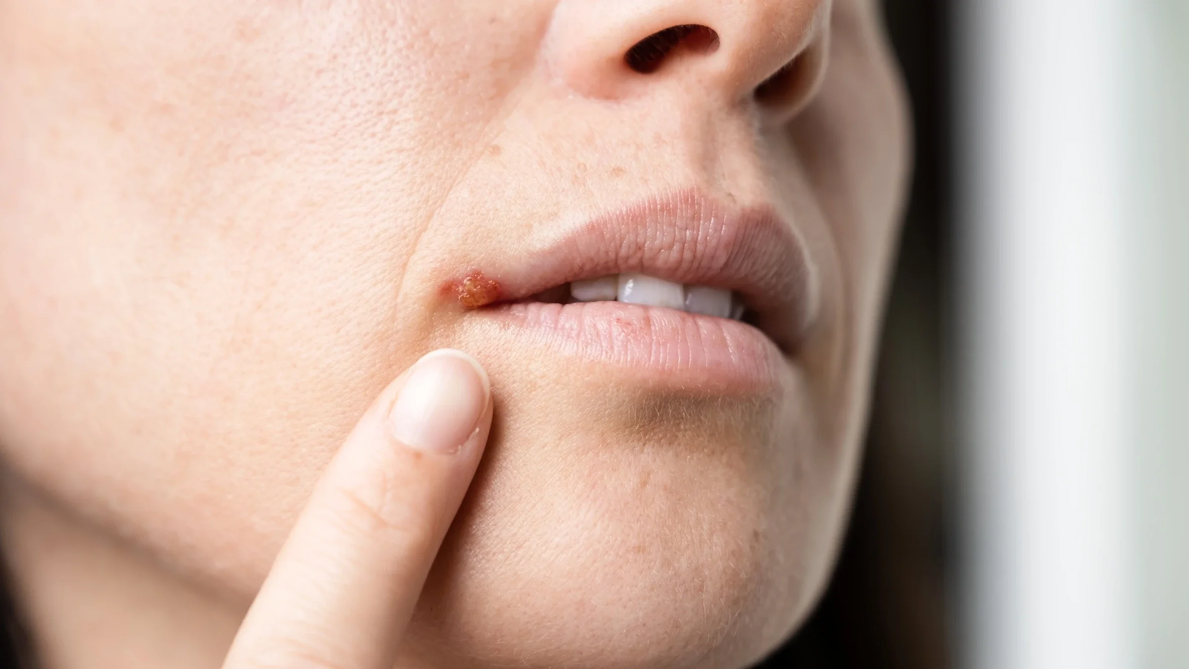 A close-up image shows a cold sore on a person’s lip. 